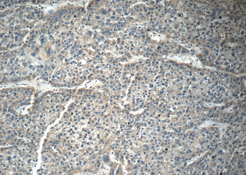 Immunohistochemistry of paraffin-embedded human liver cancer tissue slide using Catalog No:114413(RAB14 Antibody) at dilution of 1:50 (under 10x lens)