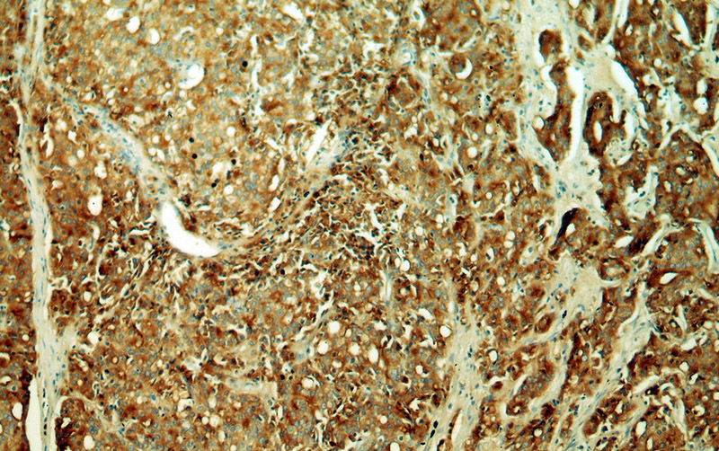 Immunohistochemical of paraffin-embedded human prostate cancer using Catalog No:107738(ACPP antibody) at dilution of 1:50 (under 10x lens)