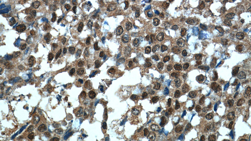 Immunohistochemistry of paraffin-embedded human colon cancer tissue slide using Catalog No:107344(ocT4 Antibody) at dilution of 1:50 (under 40x lens)