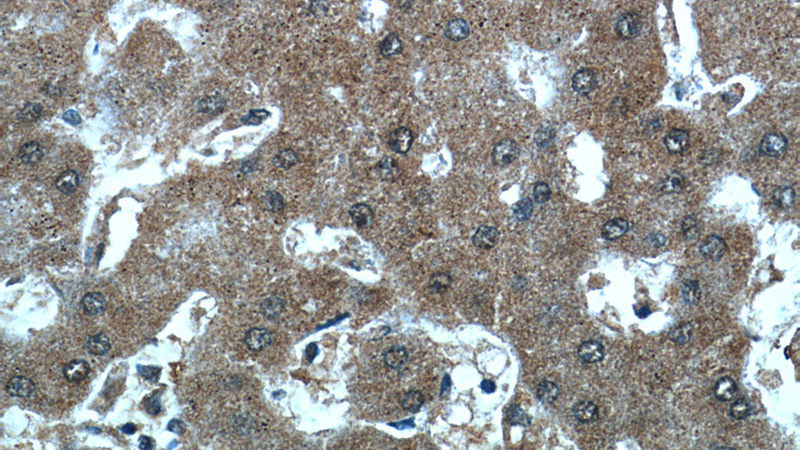 Immunohistochemistry of paraffin-embedded human hepatocirrhosis tissue slide using Catalog No:108086(ANKS3 Antibody) at dilution of 1:50 (under 40x lens)