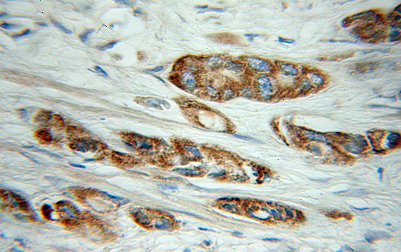 Immunohistochemical of paraffin-embedded human prostate cancer using Catalog No:109368(COG3 antibody) at dilution of 1:100 (under 10x lens)