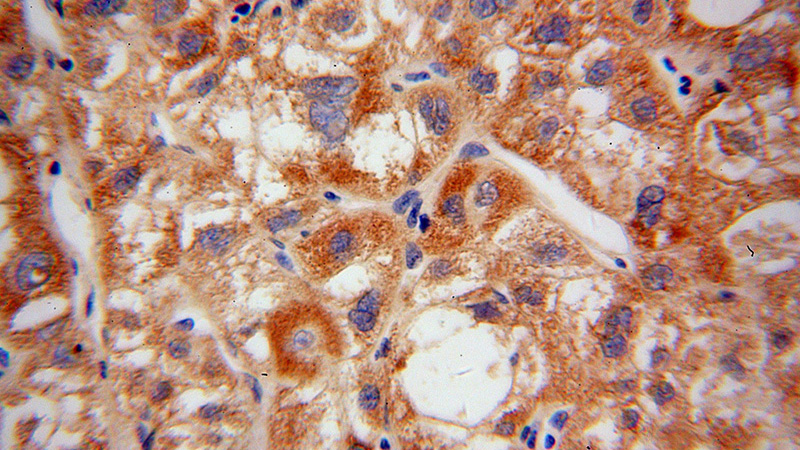 Immunohistochemical of paraffin-embedded human liver cancer using Catalog No:111341(HIBCH antibody) at dilution of 1:100 (under 40x lens)