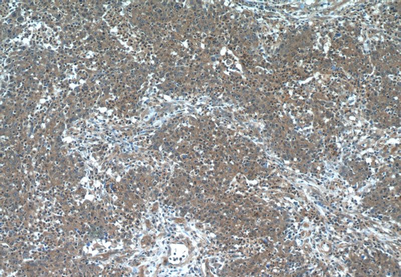 Immunohistochemistry of paraffin-embedded human colon cancer tissue slide using Catalog No:107639(TAGLN2 Antibody) at dilution of 1:50 (under 10x lens)