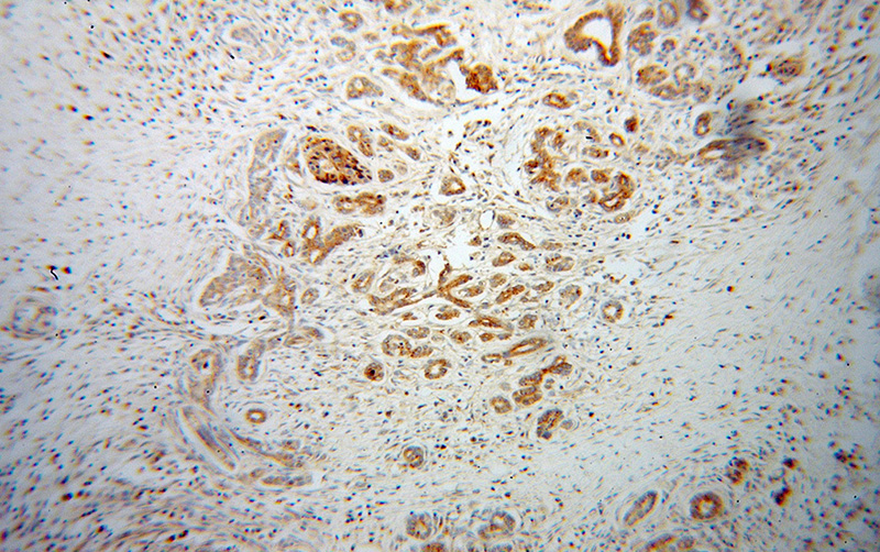 Immunohistochemical of paraffin-embedded human pancreas cancer using Catalog No:110767(GAA antibody) at dilution of 1:50 (under 10x lens)