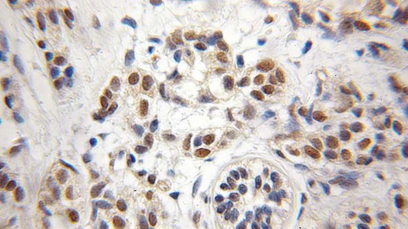 Immunohistochemical of paraffin-embedded human breast cancer using Catalog No:109555(CREST antibody) at dilution of 1:50 (under 10x lens)