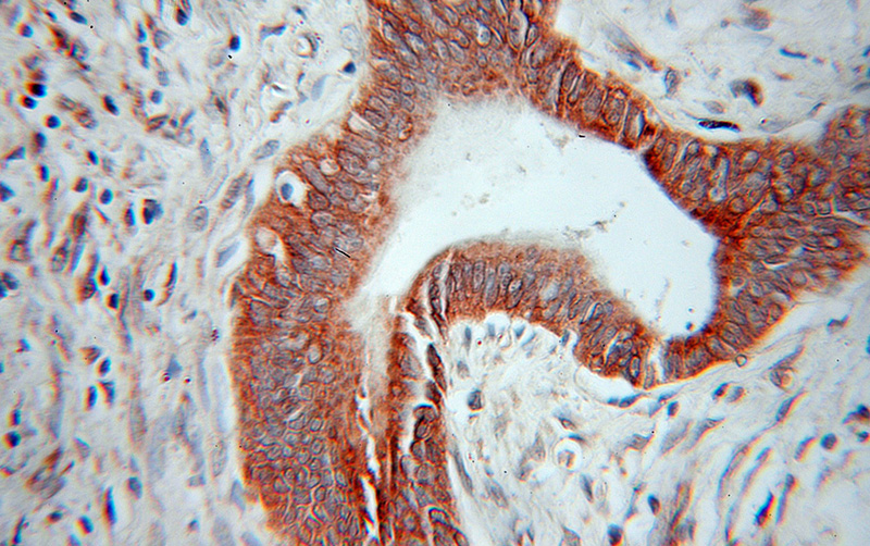 Immunohistochemical of paraffin-embedded human pancreas cancer using Catalog No:109164(CDK5RAP3 antibody) at dilution of 1:100 (under 10x lens)