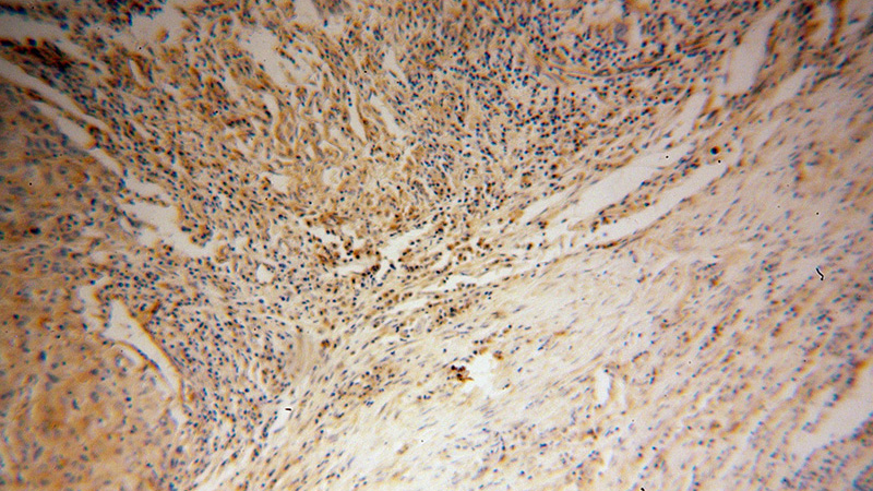 Immunohistochemical of paraffin-embedded human lung cancer using Catalog No:115792(STX12 antibody) at dilution of 1:100 (under 10x lens)