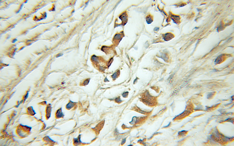 Immunohistochemical of paraffin-embedded human prostate cancer using Catalog No:110421(EYA2 antibody) at dilution of 1:50 (under 10x lens)