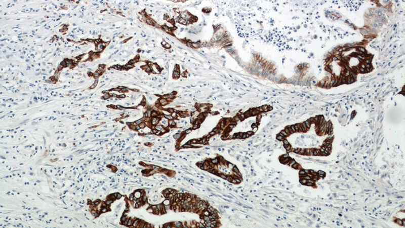 Immunohistochemical of paraffin-embedded human pancreas cancer using Catalog No:116276(TMPRSS4 antibody) at dilution of 1:50 (under 10x lens)