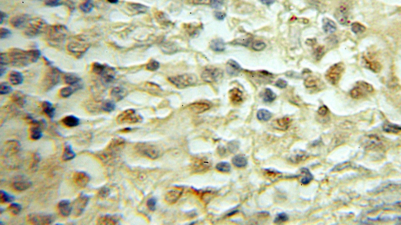 Immunohistochemical of paraffin-embedded human lymphoma using Catalog No:115433(SMARCD1 antibody) at dilution of 1:50 (under 10x lens)