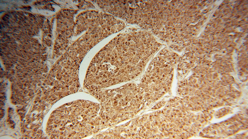 Immunohistochemical of paraffin-embedded human liver cancer using Catalog No:111340(HIBADH antibody) at dilution of 1:50 (under 10x lens)