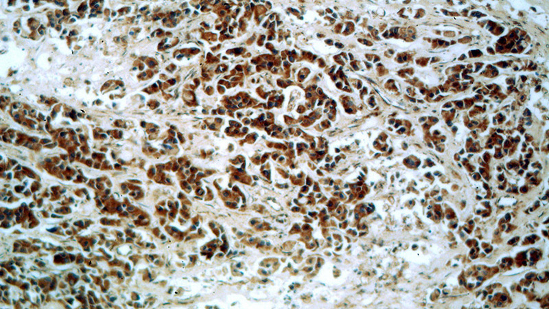 Immunohistochemical of paraffin-embedded human breast cancer using Catalog No:115679(STARD3NL antibody) at dilution of 1:100 (under 10x lens)