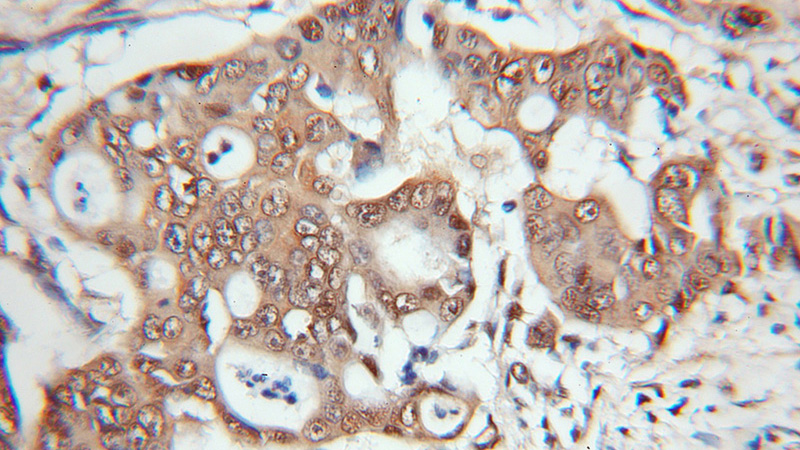Immunohistochemical of paraffin-embedded human colon cancer using Catalog No:114379(PSMB1 antibody) at dilution of 1:50 (under 10x lens)