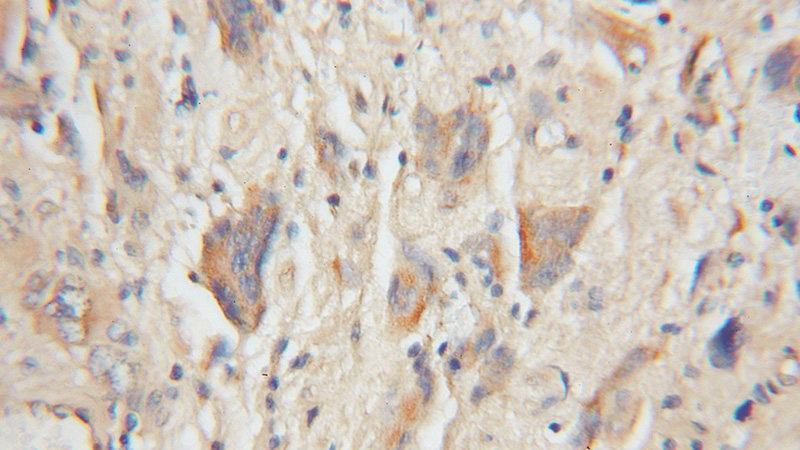 Immunohistochemical of paraffin-embedded human gliomas using Catalog No:117232(BRE antibody) at dilution of 1:50 (under 10x lens)