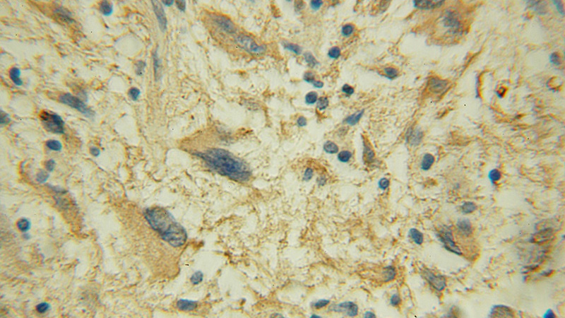 Immunohistochemical of paraffin-embedded human gliomas using Catalog No:110067(DPM1 antibody) at dilution of 1:50 (under 10x lens)