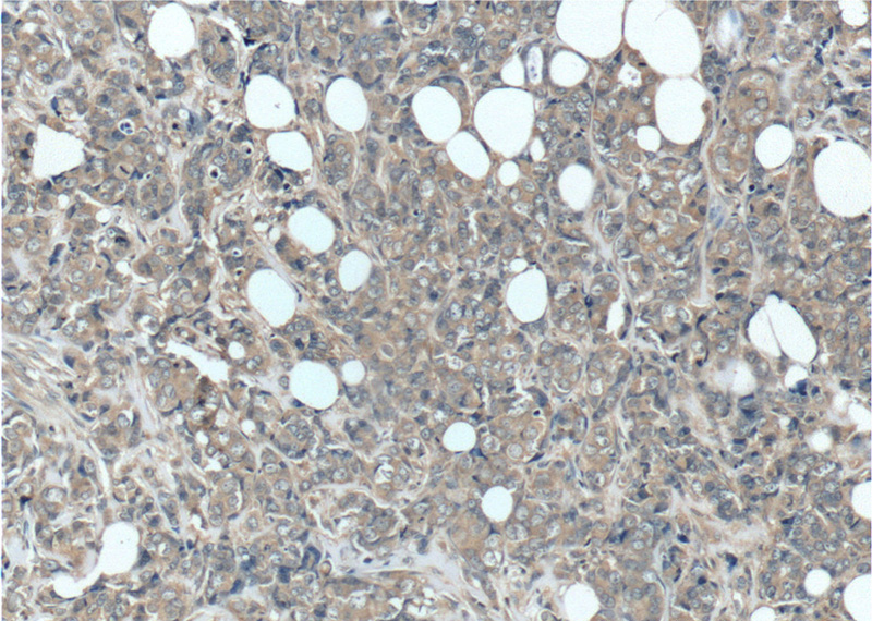 Immunohistochemistry of paraffin-embedded human breast cancer tissue slide using Catalog No:110970(GIGYF2 Antibody) at dilution of 1:50 (under 10x lens)