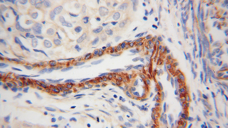 Immunohistochemical of paraffin-embedded human endometrial cancer using Catalog No:116207(TPM4 antibody) at dilution of 1:100 (under 40x lens)