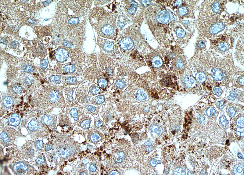 Immunohistochemical of paraffin-embedded human liver cancer using Catalog No:115219(SET antibody) at dilution of 1:100 (under 40x lens)