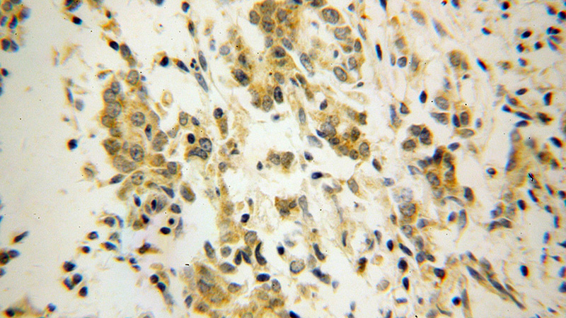Immunohistochemical of paraffin-embedded human breast cancer using Catalog No:109842(P54 antibody) at dilution of 1:100 (under 40x lens)