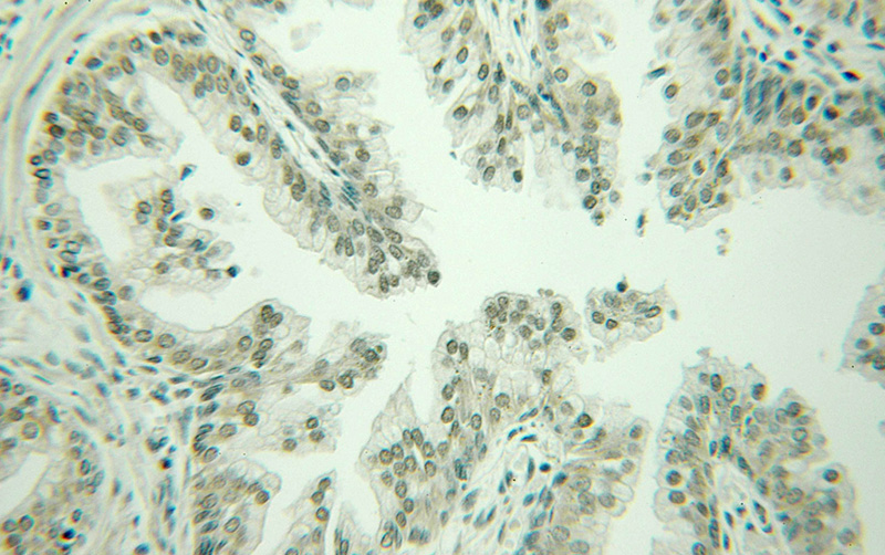 Immunohistochemical of paraffin-embedded human prostate cancer using Catalog No:112345(LSM1 antibody) at dilution of 1:100 (under 10x lens)