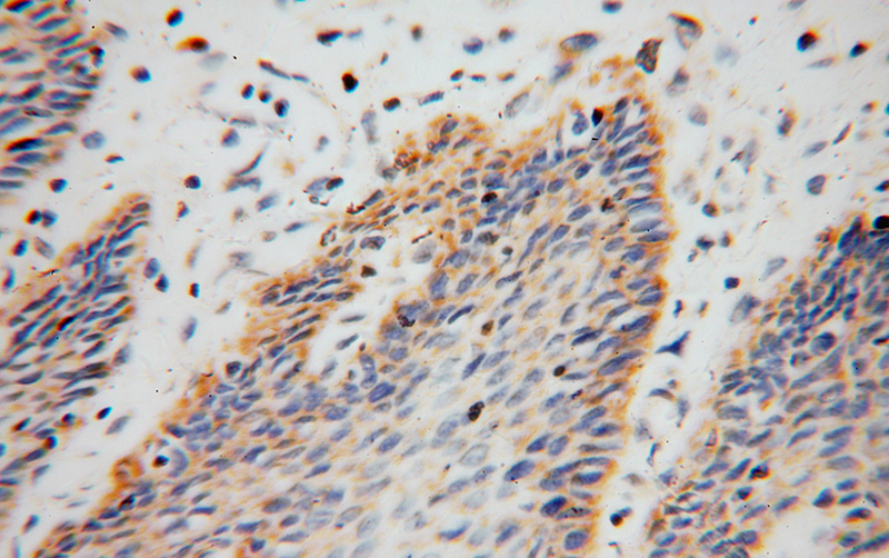 Immunohistochemical of paraffin-embedded human stomach cancer using Catalog No:108180(ARHGDIB antibody) at dilution of 1:100 (under 40x lens)