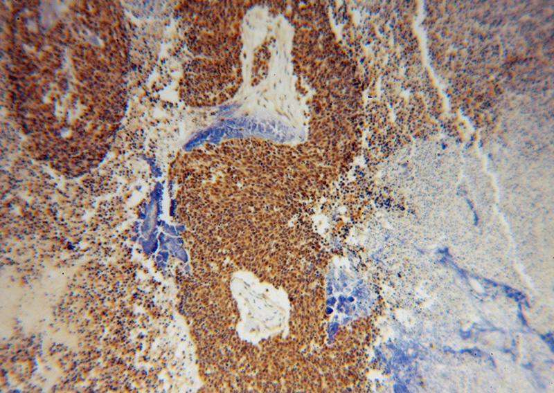 Immunohistochemical of paraffin-embedded human lung cancer using Catalog No:116511(UBE2I-Specific antibody) at dilution of 1:50 (under 10x lens)