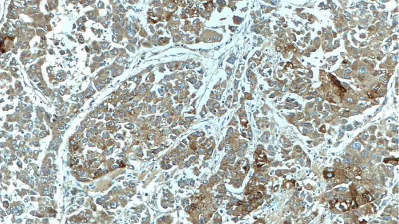 Immunohistochemistry of paraffin-embedded human liver cancer tissue slide using Catalog No:114059(PON2 Antibody) at dilution of 1:200 (under 10x lens)