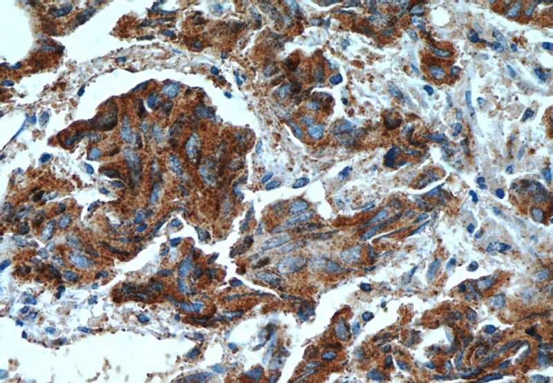 Immunohistochemistry of paraffin-embedded human prostate cancer tissue slide using Catalog No:110044(DocK4 Antibody) at dilution of 1:50 (under 40x lens)
