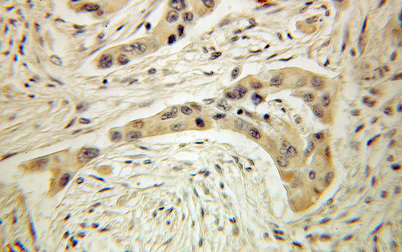 Immunohistochemical of paraffin-embedded human lung cancer using Catalog No:112996(MYOT antibody) at dilution of 1:100 (under 10x lens)