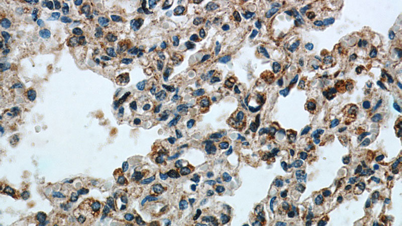 Immunohistochemical of paraffin-embedded human lung using Catalog No:114499(RABGGTA antibody) at dilution of 1:100 (under 40x lens)