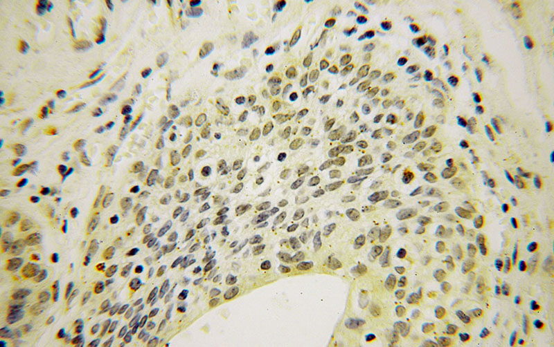 Immunohistochemical of paraffin-embedded human colon cancer using Catalog No:111792(ING2 antibody) at dilution of 1:50 (under 40x lens)
