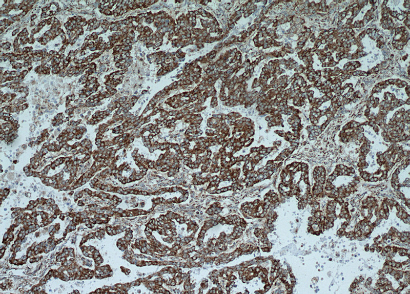 Immunohistochemical of paraffin-embedded human ovary tumor using Catalog No:111865(ITGB6 antibody) at dilution of 1:50 (under 10x lens)