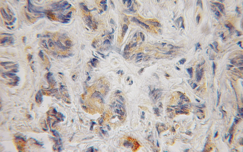 Immunohistochemical of paraffin-embedded human prostate cancer using Catalog No:117099(BCL2L14 antibody) at dilution of 1:100 (under 10x lens)