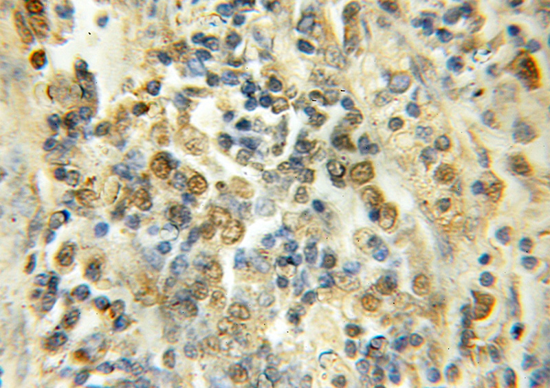 Immunohistochemical of paraffin-embedded human lung cancer using Catalog No:111523(PSMC3IP antibody) at dilution of 1:50 (under 10x lens)
