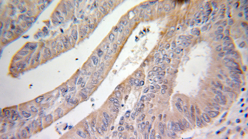 Immunohistochemical of paraffin-embedded human colon cancer using Catalog No:107806(ABCF2 antibody) at dilution of 1:100 (under 25x lens)
