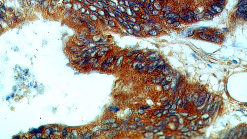 Immunohistochemical of paraffin-embedded human colon cancer using Catalog No:114353(PYCR1 antibody) at dilution of 1:50 (under 40x lens)
