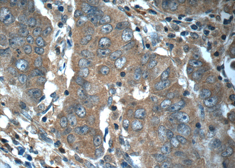 Immunohistochemistry of paraffin-embedded human prostate cancer tissue slide using Catalog No:114523(RAF1 Antibody) at dilution of 1:50 (under 40x lens)
