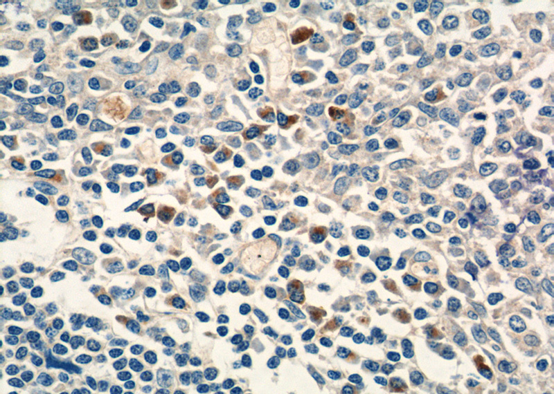 Immunohistochemistry of paraffin-embedded human tonsillitis tissue slide using Catalog No:113741(PCM1 Antibody) at dilution of 1:50 (under 40x lens)