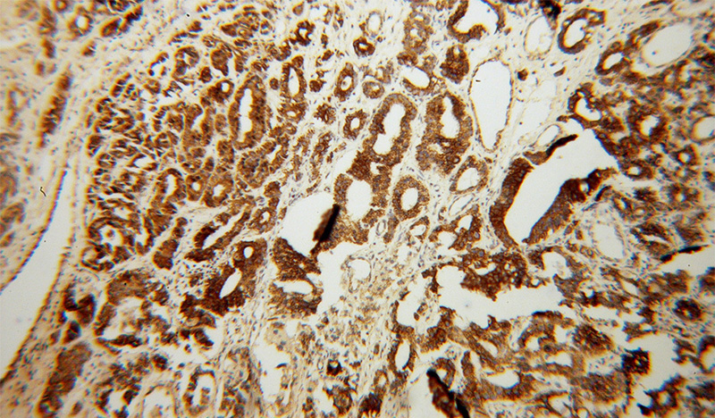 Immunohistochemical of paraffin-embedded human gliomas using Catalog No:111042(GLUD1 antibody) at dilution of 1:100 (under 10x lens)