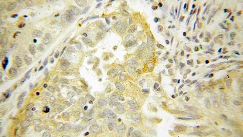 Immunohistochemical of paraffin-embedded human endometrial cancer using Catalog No:110233(ELP4 antibody) at dilution of 1:50 (under 40x lens)