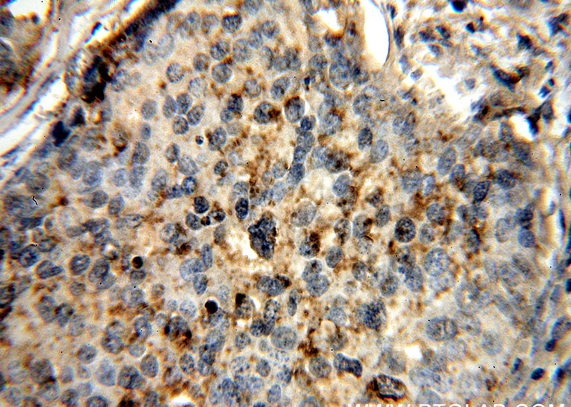 Immunohistochemical of paraffin-embedded human cervical cancer using Catalog No:115086(SEC61B antibody) at dilution of 1:50 (under 40x lens)
