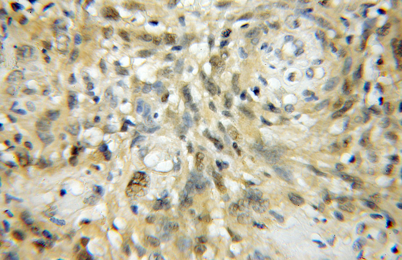 Immunohistochemical of paraffin-embedded human gliomas using Catalog No:112675(MLF2 antibody) at dilution of 1:50 (under 10x lens)