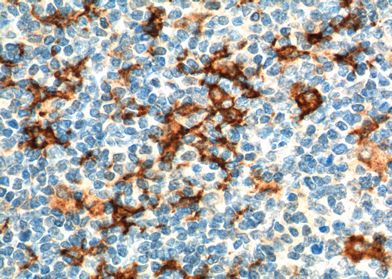 Immunohistochemistry of paraffin-embedded human tonsillitis tissue slide using Catalog No:109059(CD163 Antibody) at dilution of 1:200 (under 40x lens). heat mediated antigen retrieved with Tris-EDTA buffer(pH9).