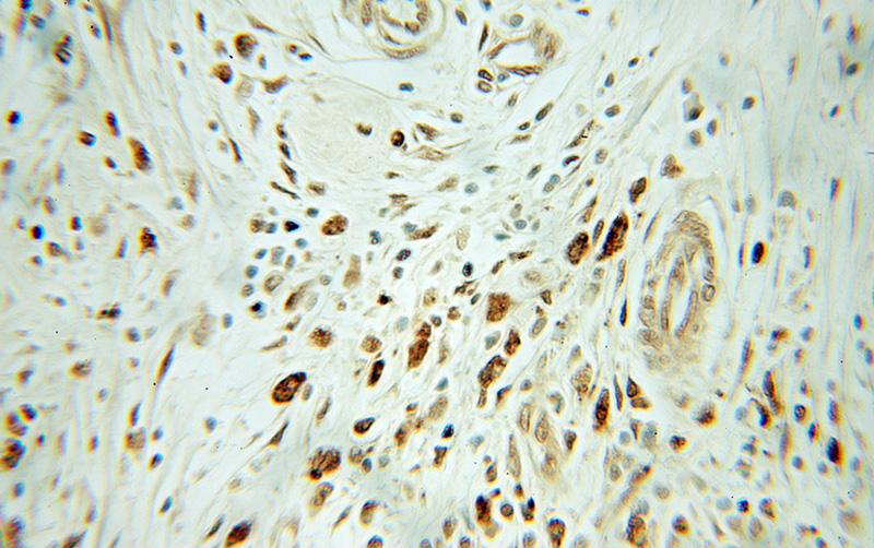 Immunohistochemical of paraffin-embedded human pancreas cancer using Catalog No:114645(RGS2 antibody) at dilution of 1:50 (under 10x lens)