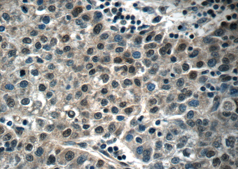 Immunohistochemistry of paraffin-embedded human liver cancer tissue slide using Catalog No:110746(FOXA2 Antibody) at dilution of 1:50 (under 40x lens)