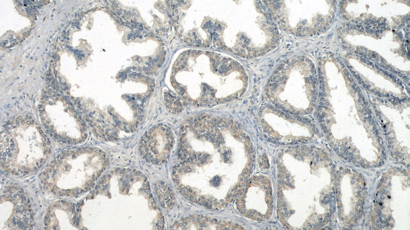 Immunohistochemical of paraffin-embedded human prostate hyperplasia using Catalog No:114021(PMEPA1 antibody) at dilution of 1:50 (under 10x lens)
