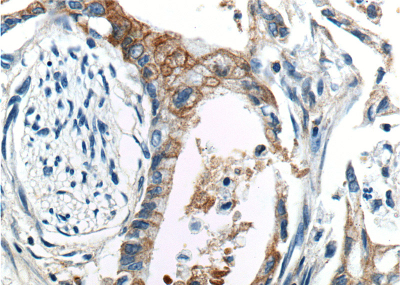 Immunohistochemistry of paraffin-embedded human pancreas cancer tissue slide using Catalog No:107763(ADAM17-Specific Antibody) at dilution of 1:200 (under 40x lens).