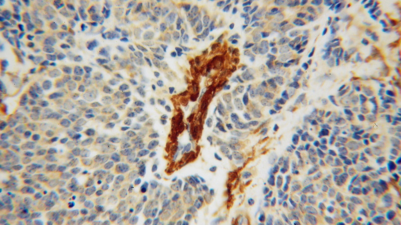 Immunohistochemical of paraffin-embedded human lung cancer using Catalog No:111936(ISCU antibody) at dilution of 1:50 (under 40x lens)