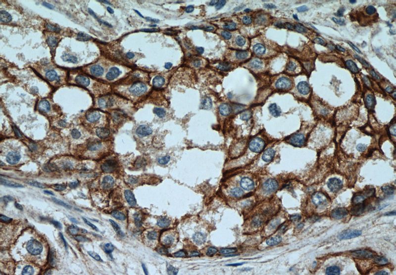 Immunohistochemistry of paraffin-embedded human breast cancer tissue slide using Catalog No:117132(B-catenin Antibody) at dilution of 1:200 (under 40x lens)