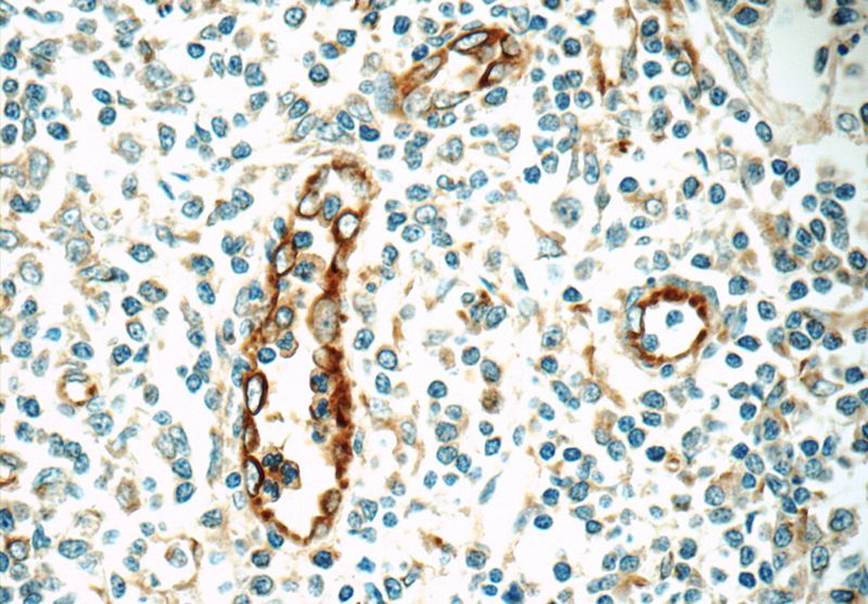 Immunohistochemistry of paraffin-embedded human tonsillitis tissue slide using Catalog No:109386(CLEC4M Antibody) at dilution of 1:50 (under 40x lens)